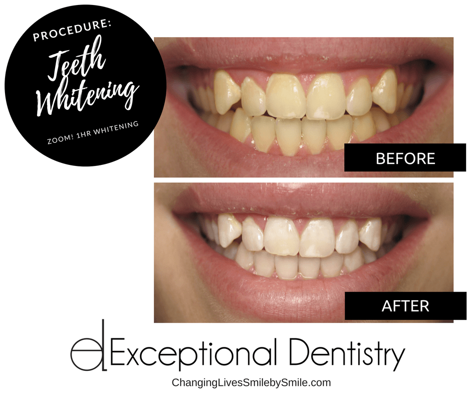 Teeth Whitening in Palmdale, CA