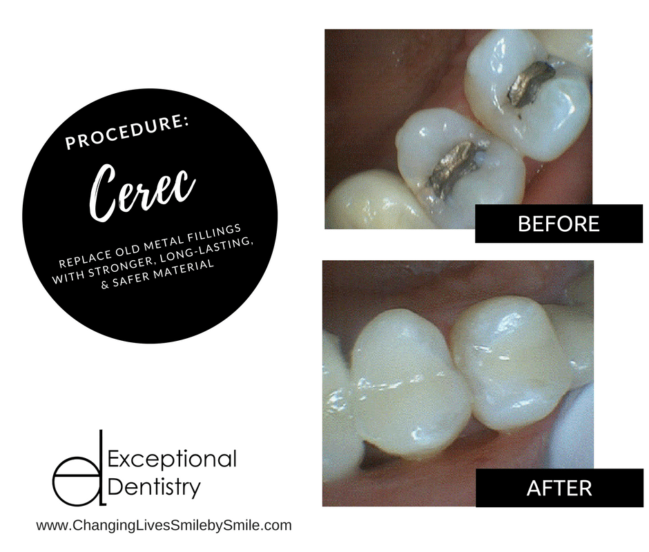 Cerec Crowns and Restorations 