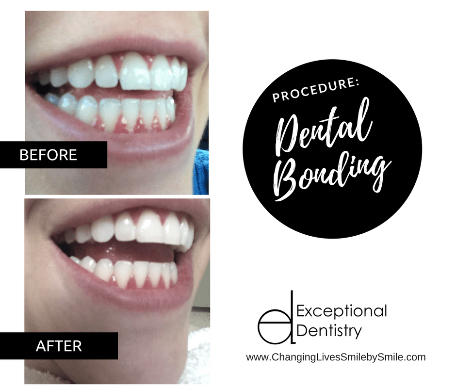 Dental Bonding B&A in Palmdale, CA