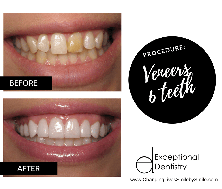 Veneers Upper Teeth | Exceptional Dentistry