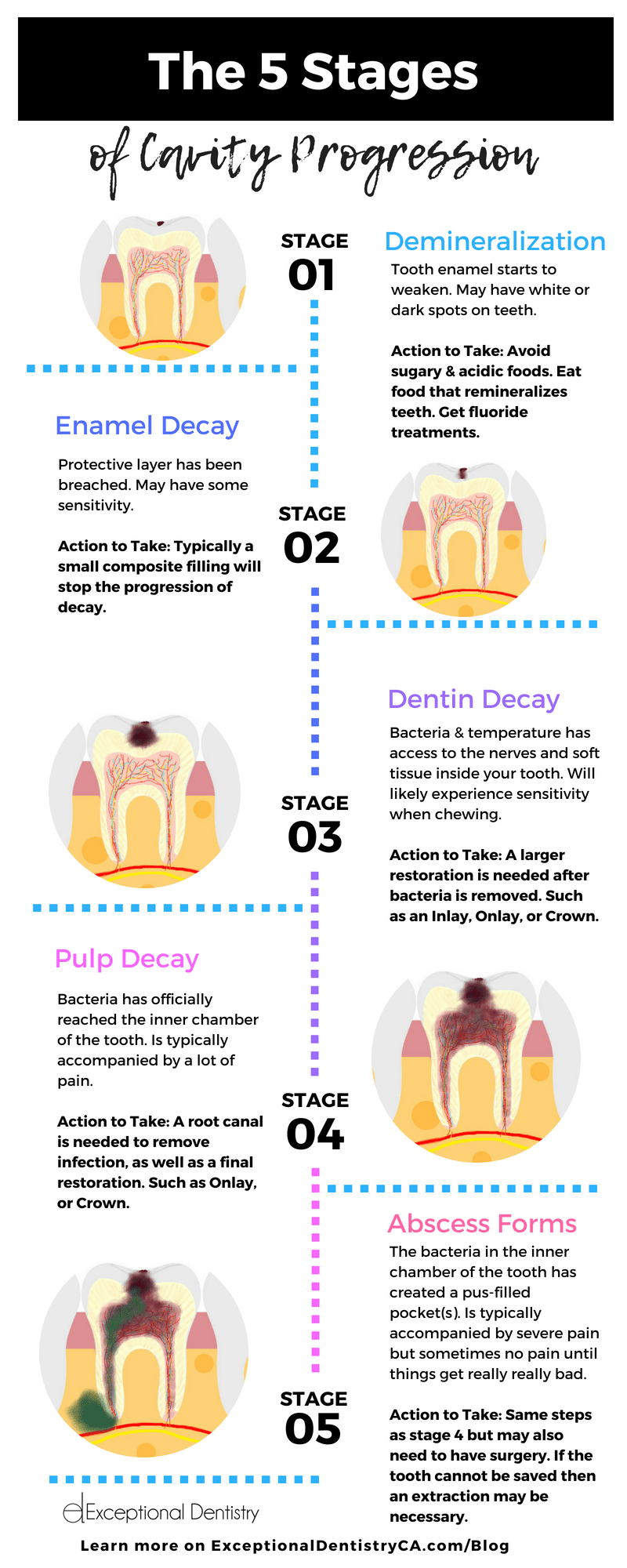 5 Stages of Cavity Progression