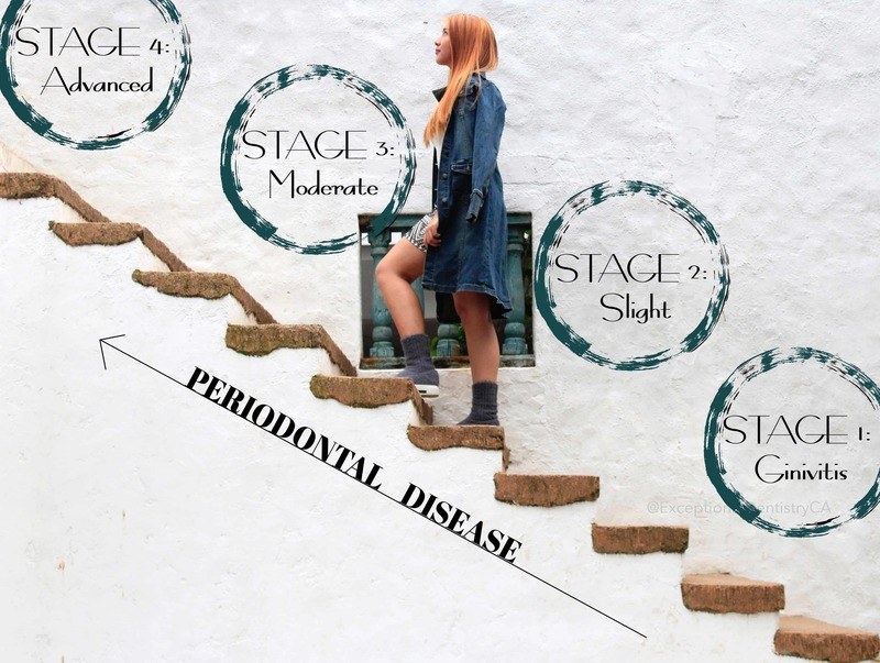 Periodontal Disease Stage chart